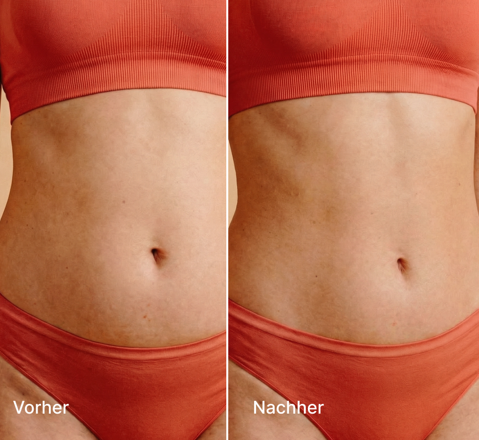 Vorher "Vorher" und "Nachher" Vergleichsaufnahme des weiblichen Bauchs in roter Unterwäsche